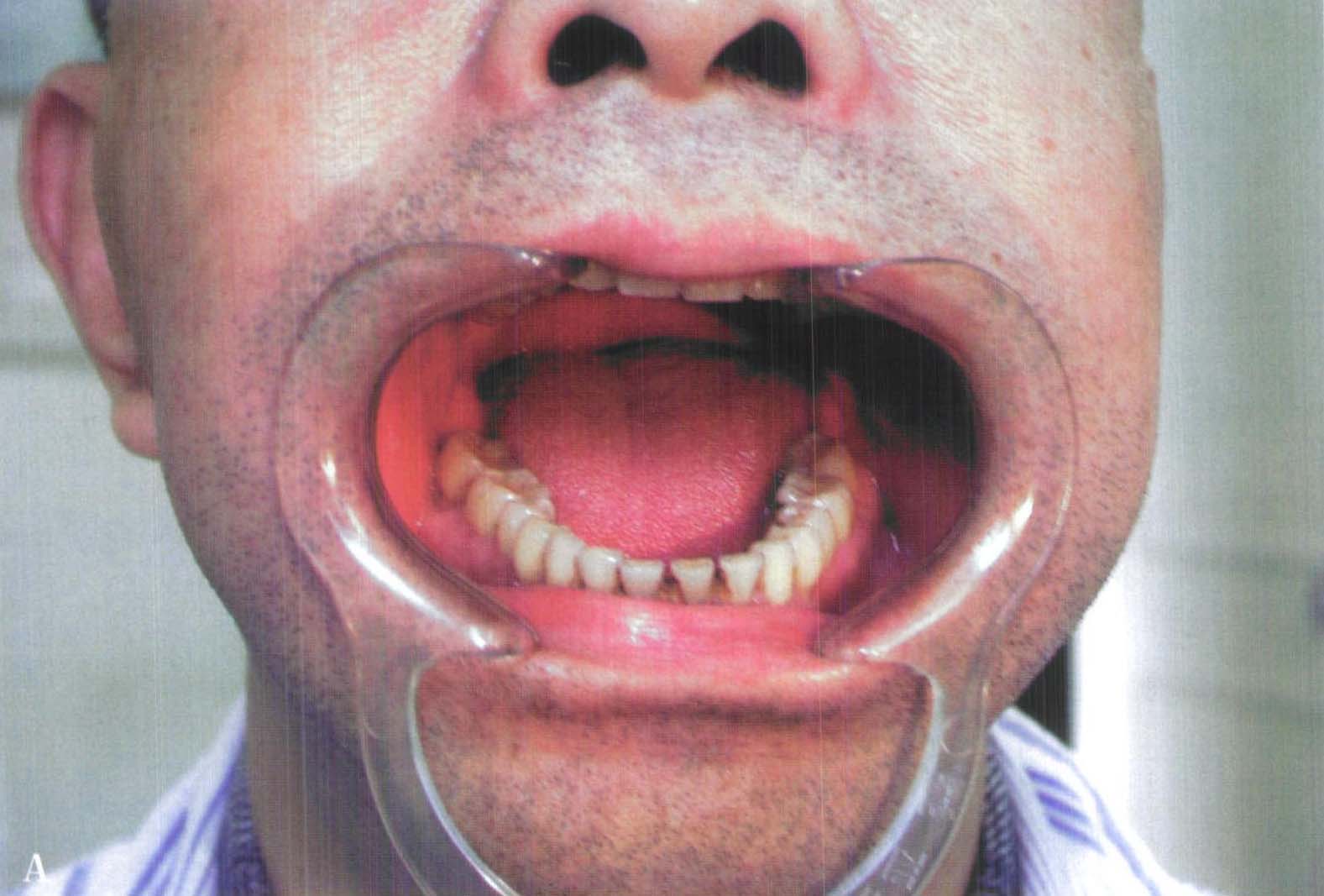 6 发生回避现象的前磨牙早期治疗，使其正常萌出-口腔科学-医学